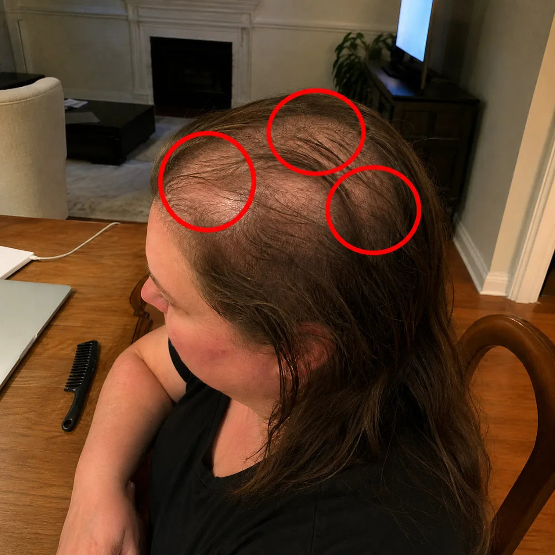 Close-up of thinning areas on the scalp